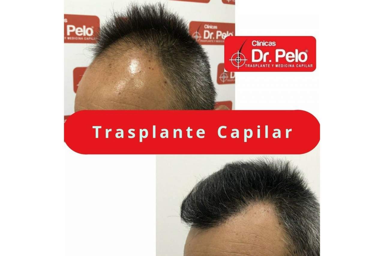 ¿Qué opinan los clientes sobre el injerto capilar de las Clínicas Dr. Pelo en Sevilla?