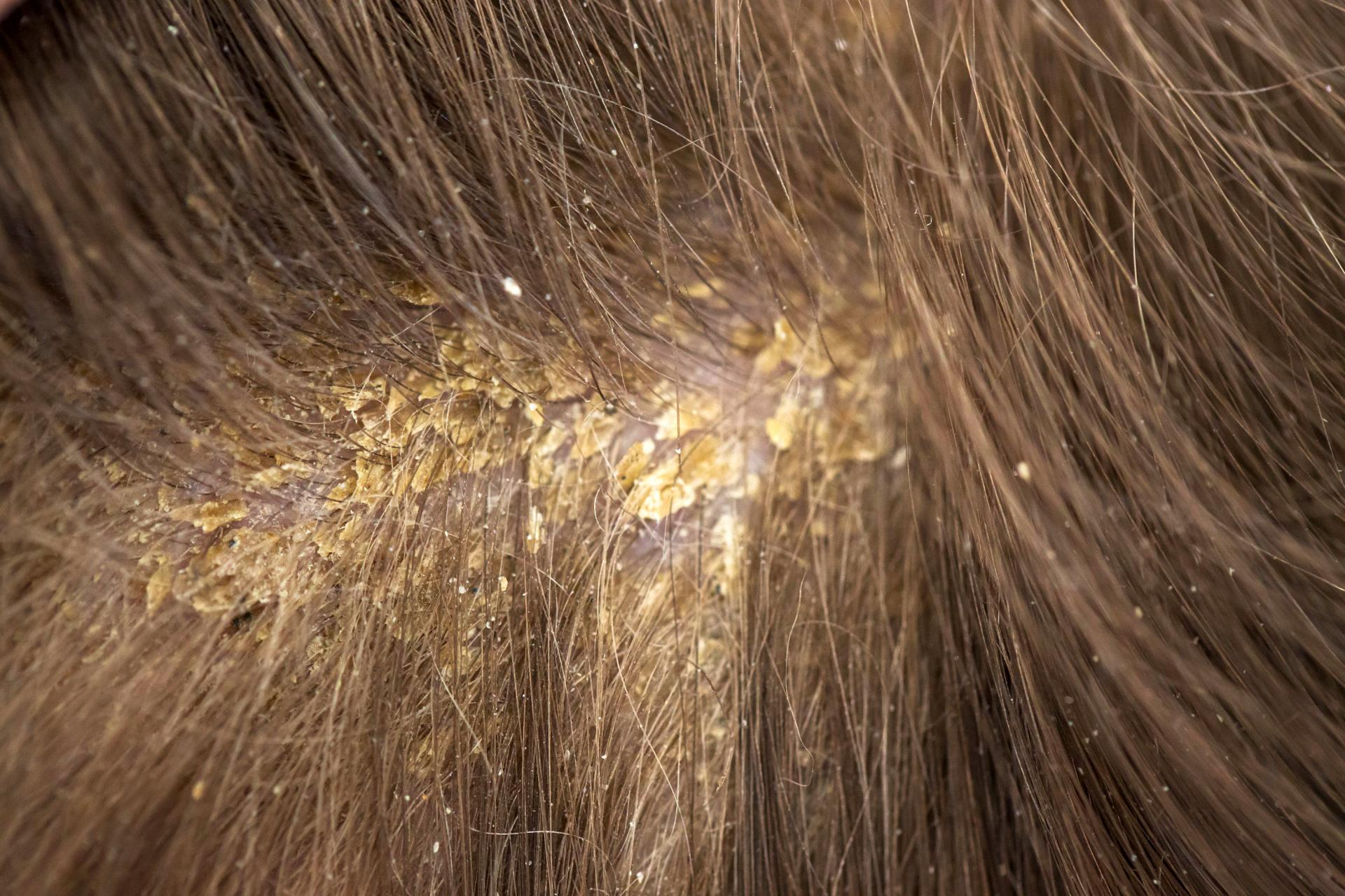 Costras en el cuero cabelludo, el tratamiento creado por el Laboratorio Géomer Pure Nature