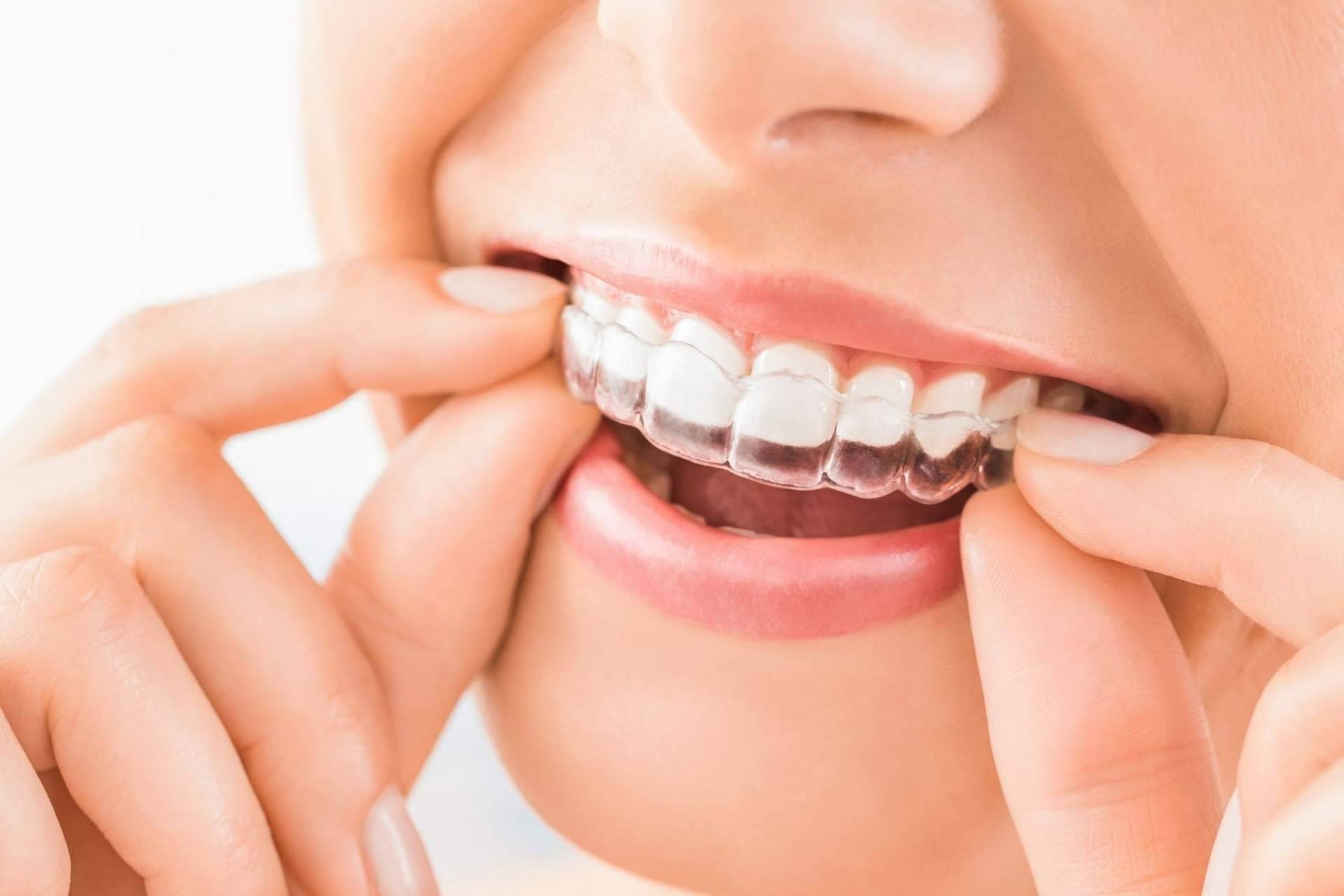 Clínica Viasalud: el efecto rejuvenecedor de la estética dental