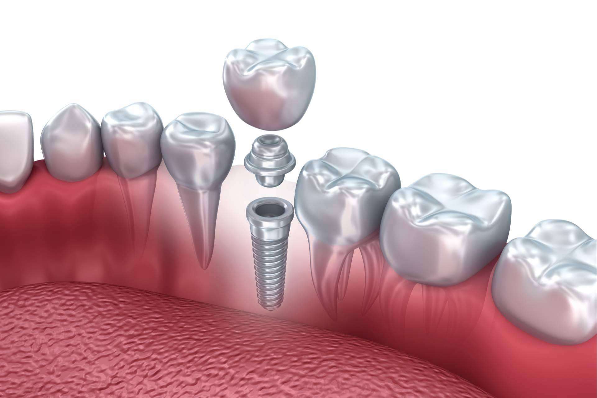 ¿Cuánto cuesta un implante dental?: implante dental en Valladolid por Clínica Dental Heins