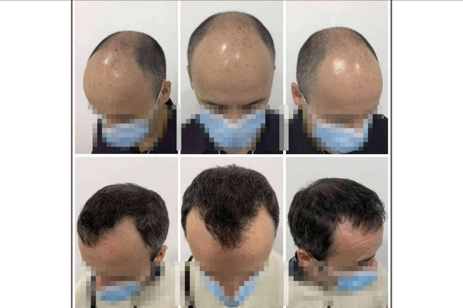 Tratamiento de mesoterapia capilar del Dr. Bruno Jacobovski