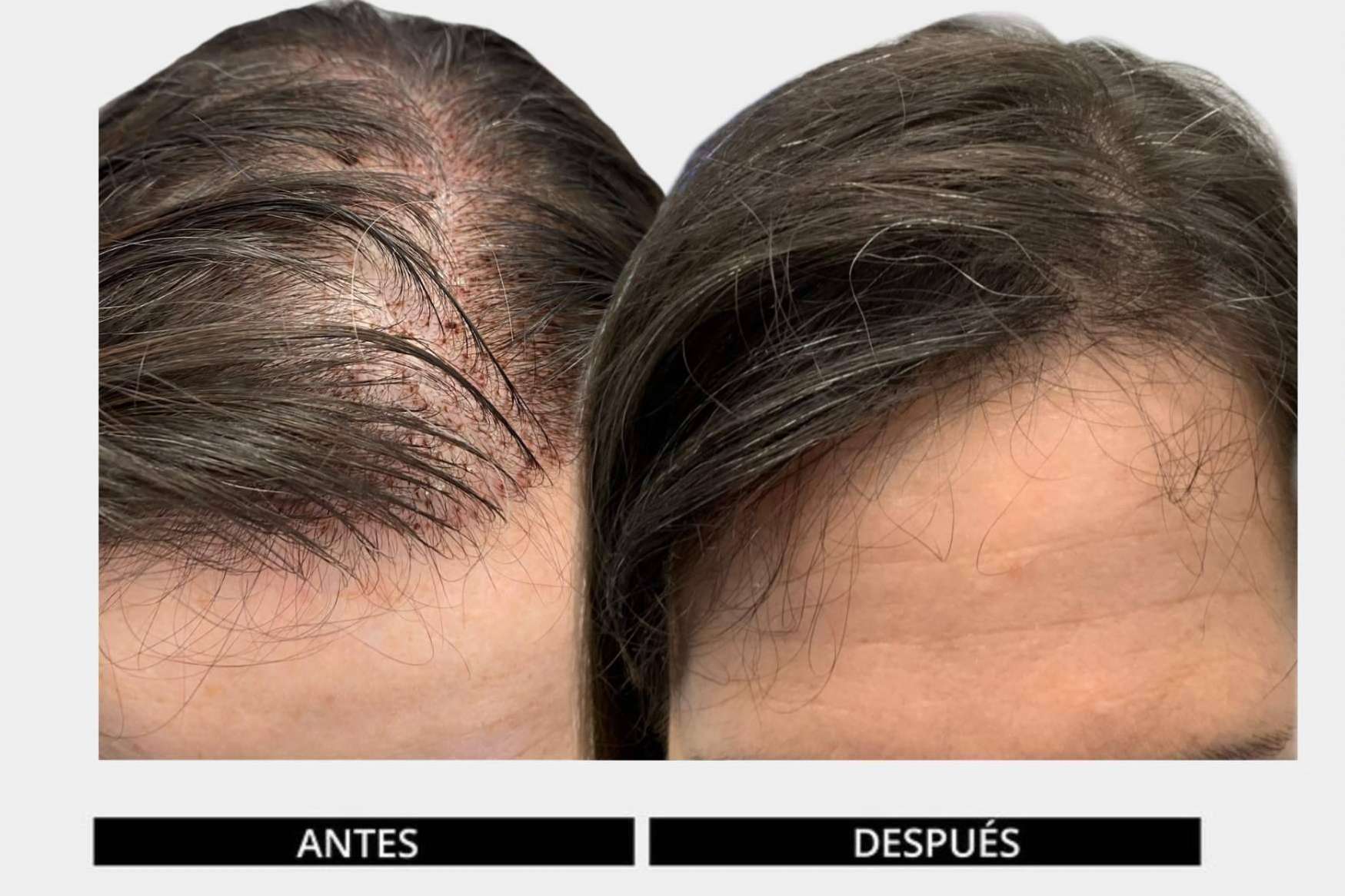 La dedicación es la clave del éxito de los tratamientos con el método DHI, que logra retrasar el efecto de la calvicie