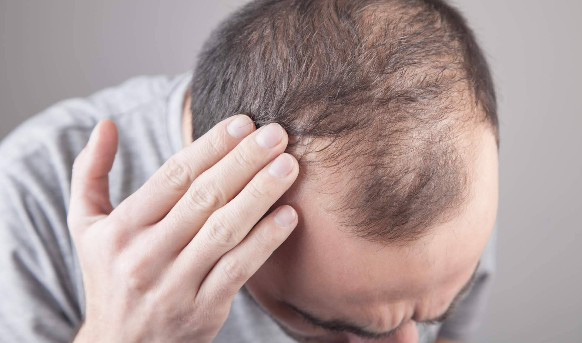 Élite Capilar combate la alopecia con injertos capilares efectivos
