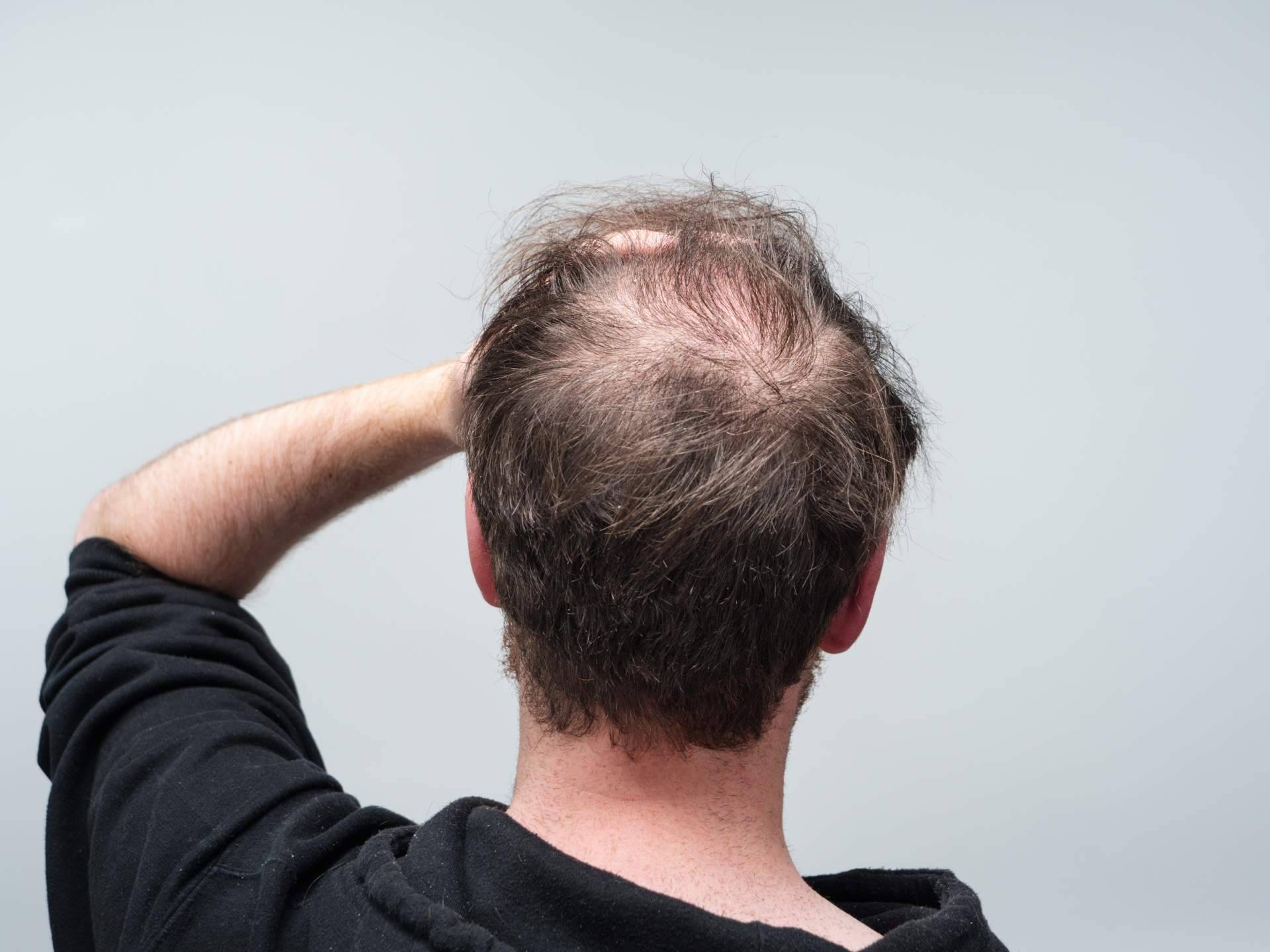 Los diferentes tipos de caídas del pelo, por el Laboratorio Géomer