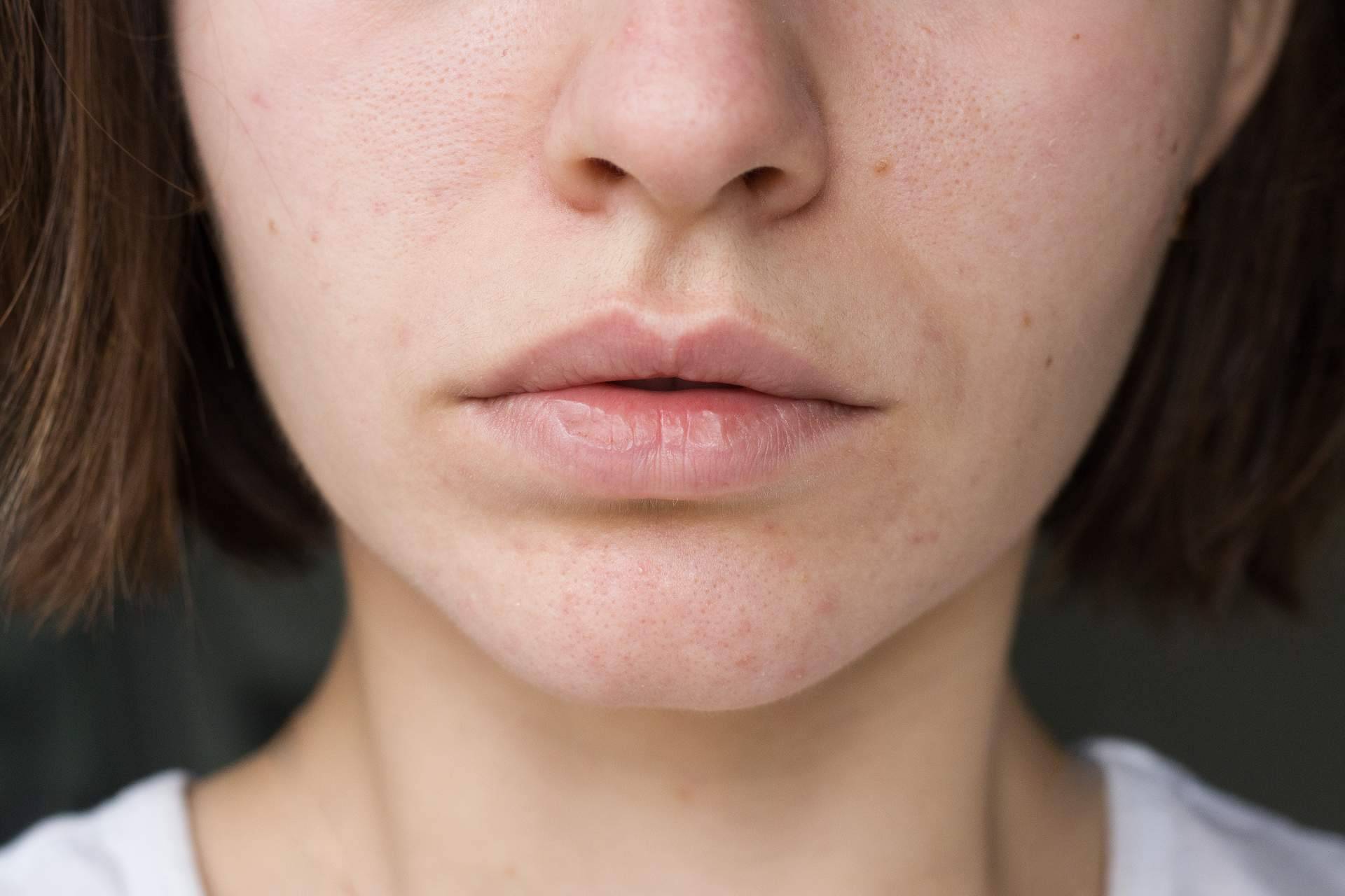 Tratamientos para las manchas en la piel y cómo prevenir para el verano, por Farmacia Laura Garín