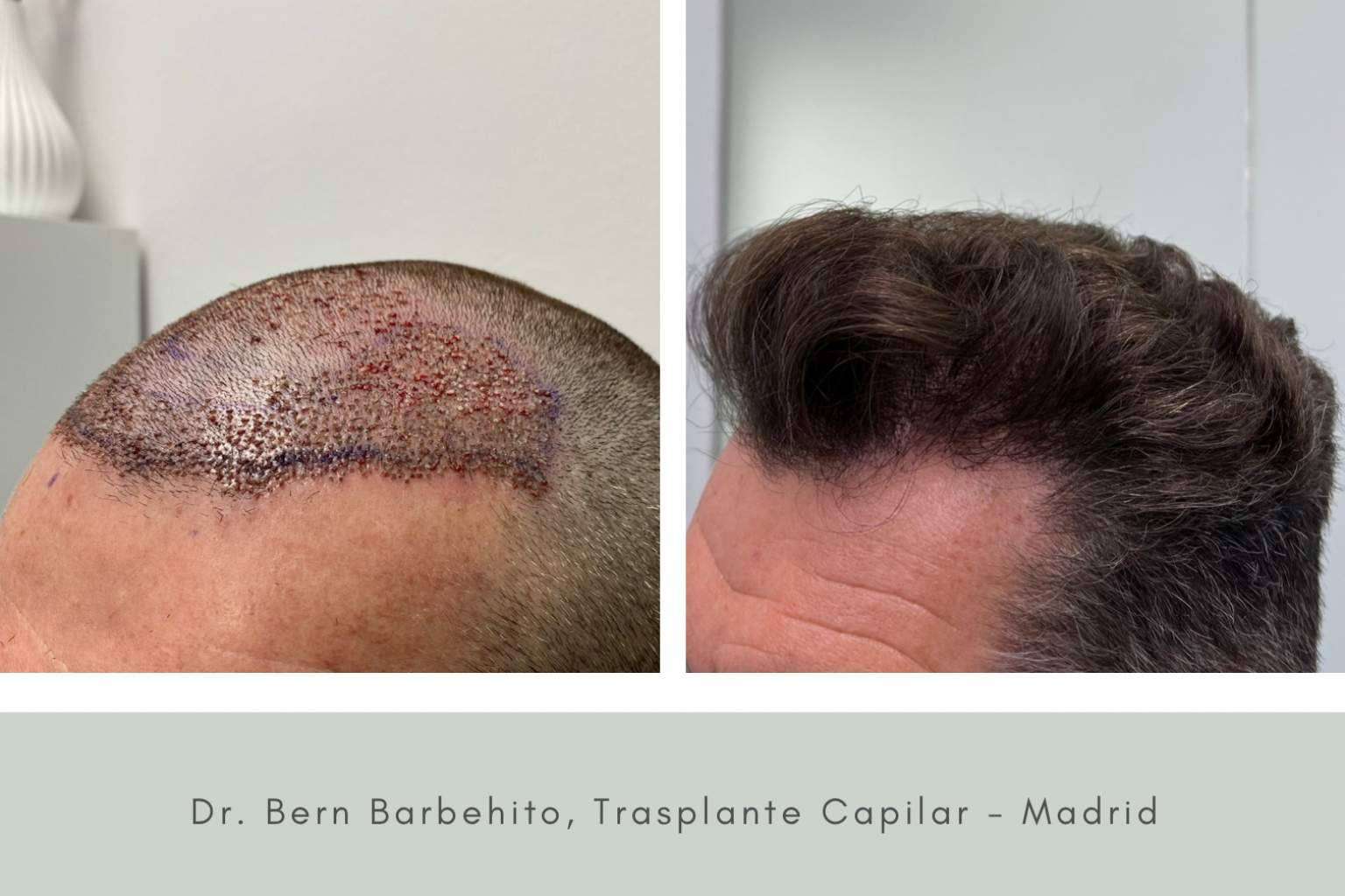 Todo lo que se debe saber sobre el postoperatorio de la cirugía capilar, de la mano del Doctor Bern