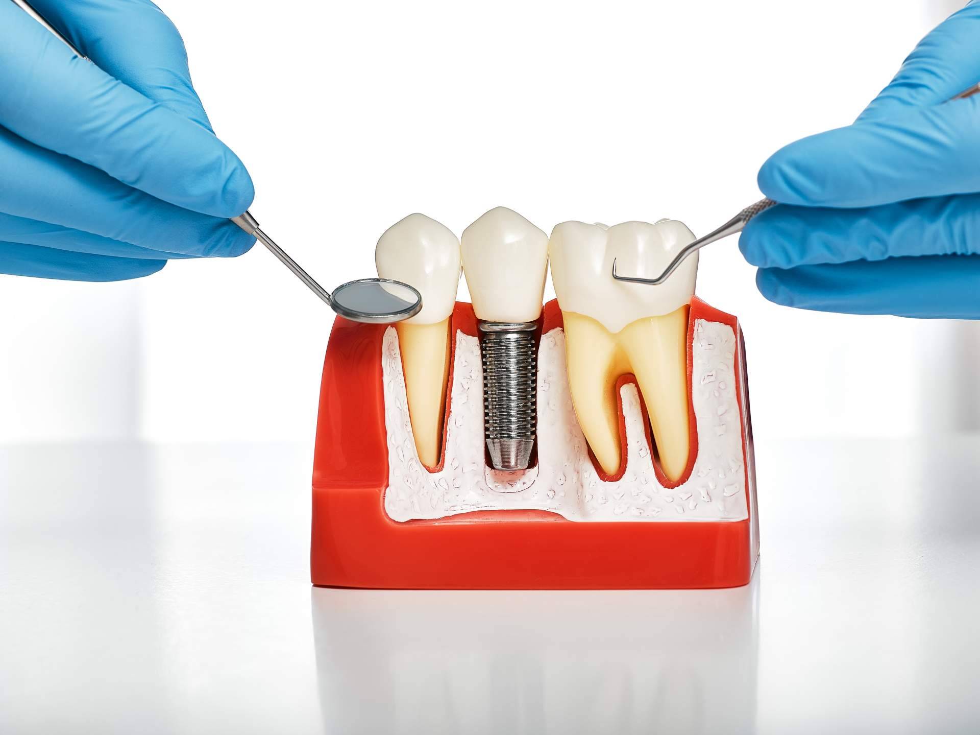 Implantes postextracción con carga inmediata, la técnica por la que apuesta Clínica Dental Sonrisas para conseguir una dentadura de 10 en sus pacientes