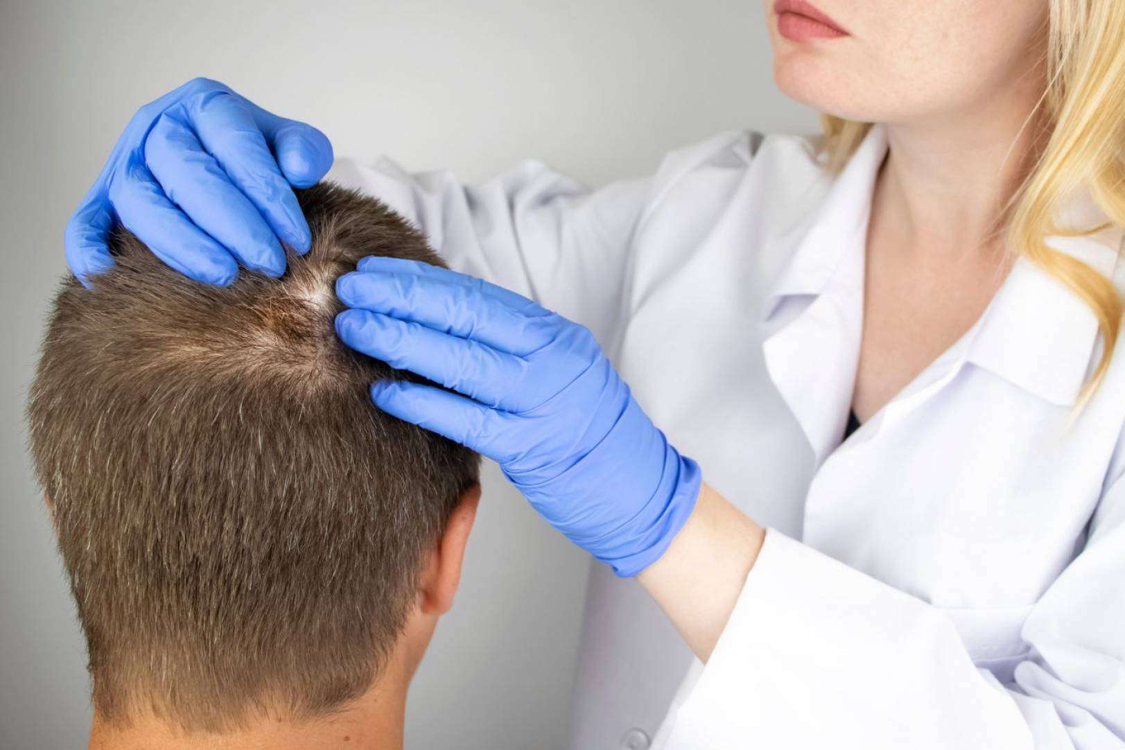 Los diferentes tipos de alopecia, por la Clínica Capilar Laura Agrelo