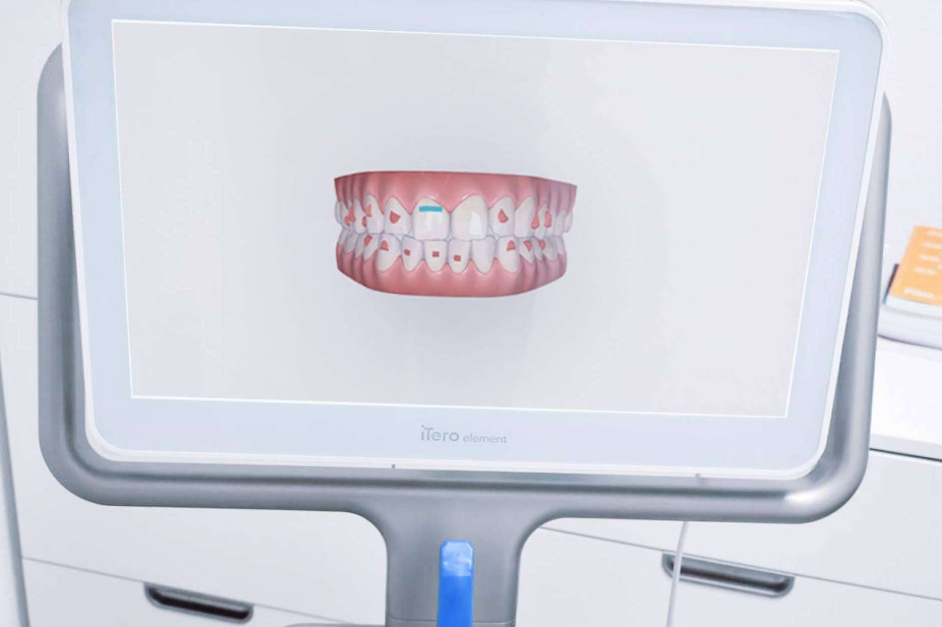 La ortodoncia invisible Invisalign, la alternativa perfecta a los brackets