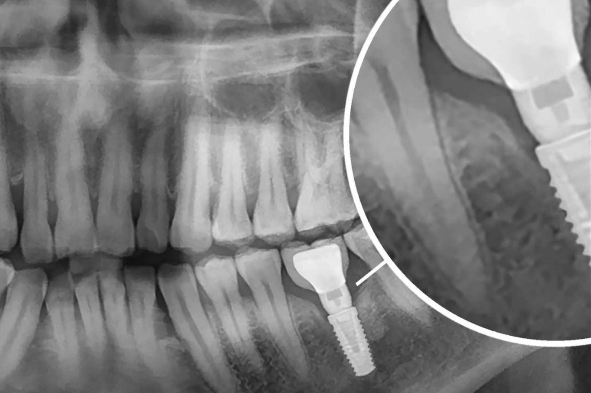 Recuperar la funcionalidad de la boca con implantes dentales en la clínica dental del Dr. Román Hernández