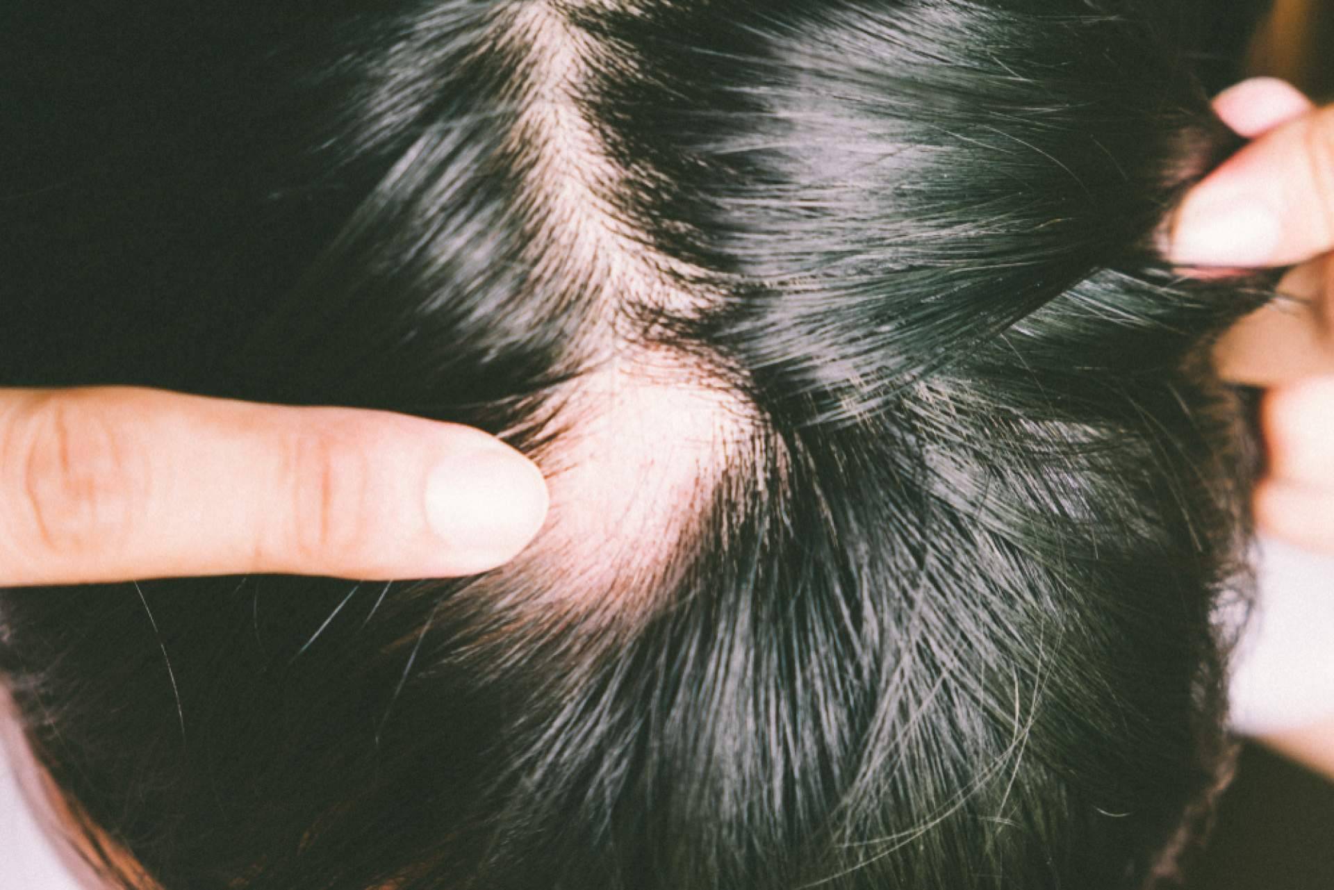 Alopecia Areata, ¿qué es y cómo disimularla?
