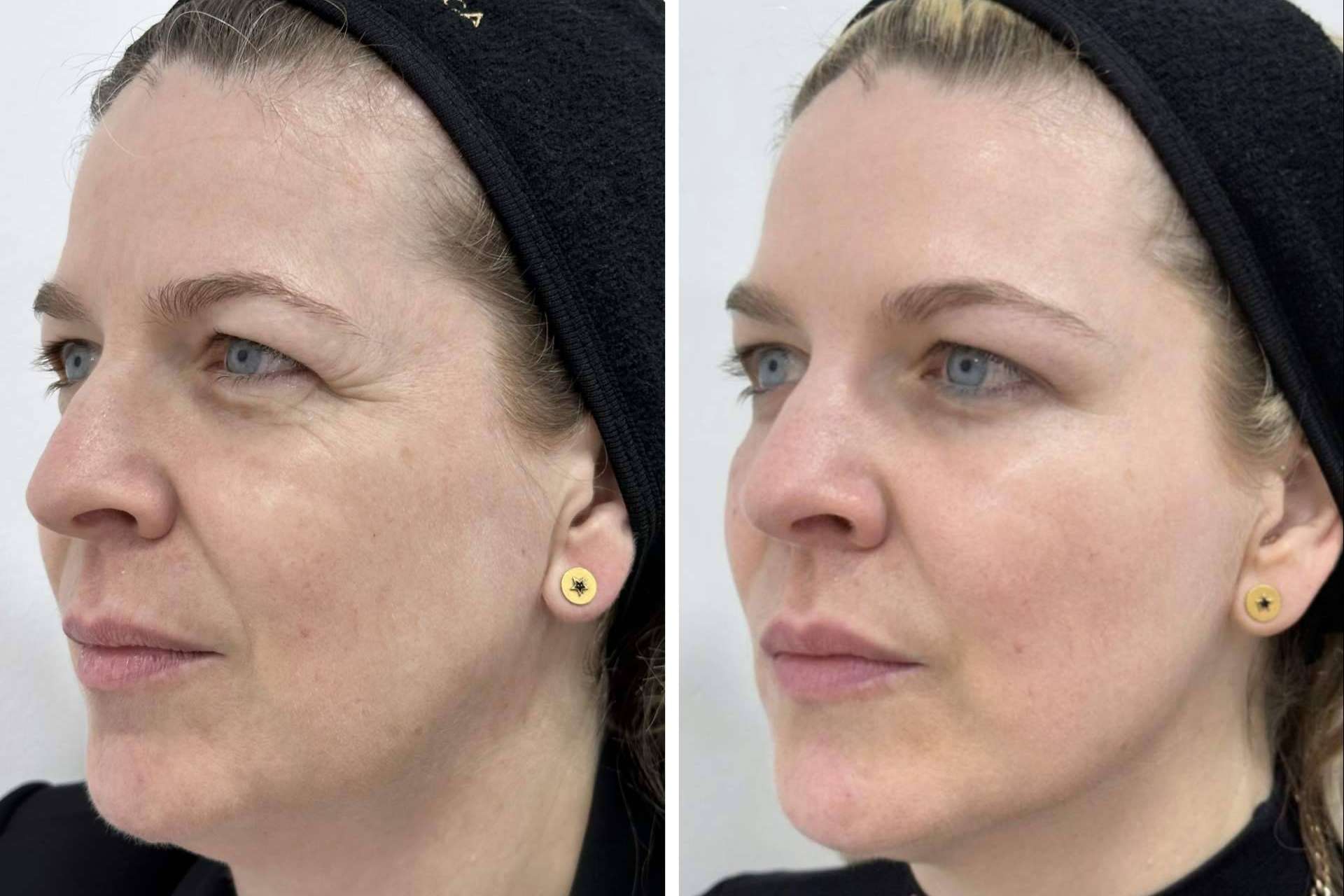Mejorar la apariencia con los tratamientos faciales de Clínica VISO