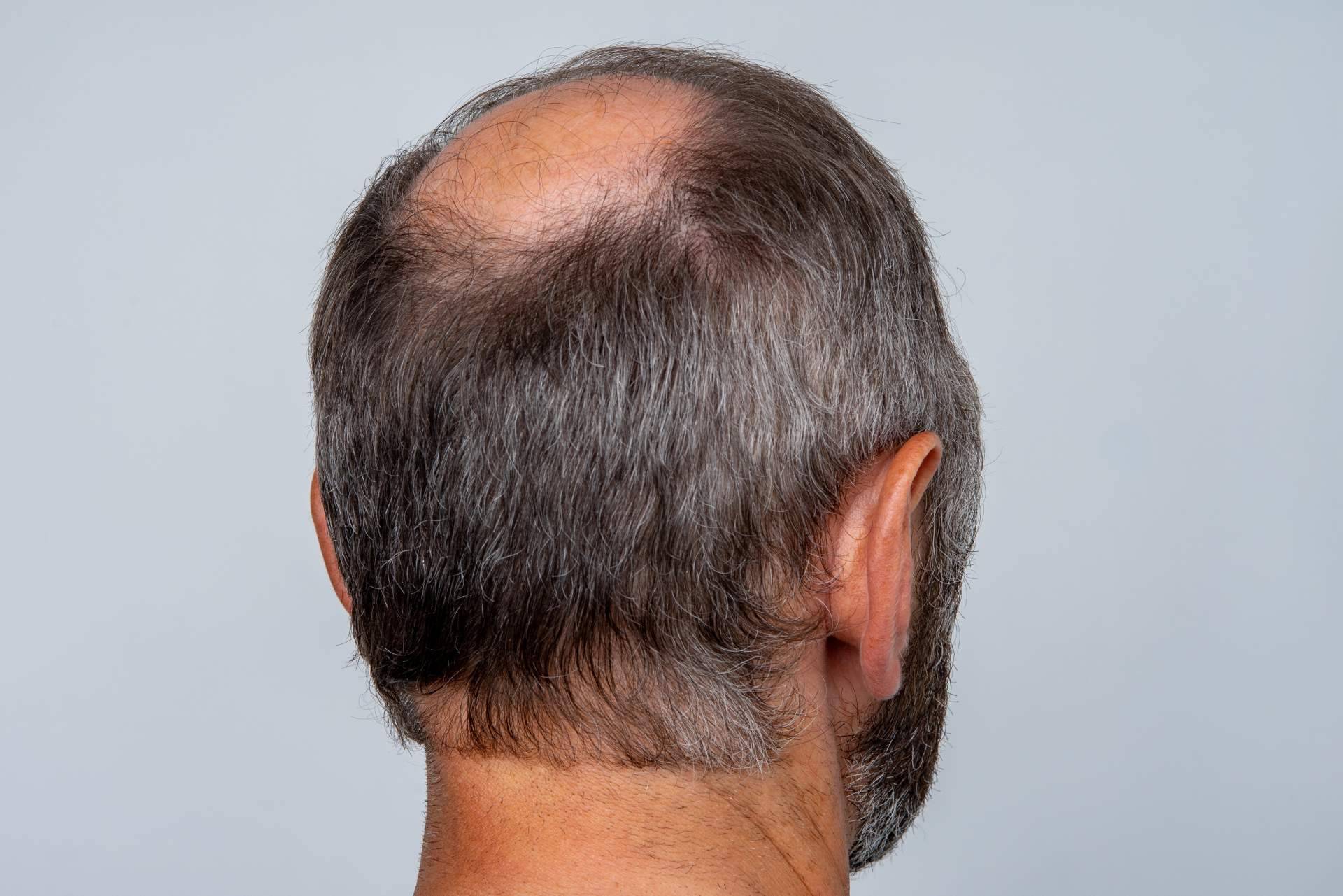 Microinjerto capilar para hombres en verano, en Capilar Innovation Clinic