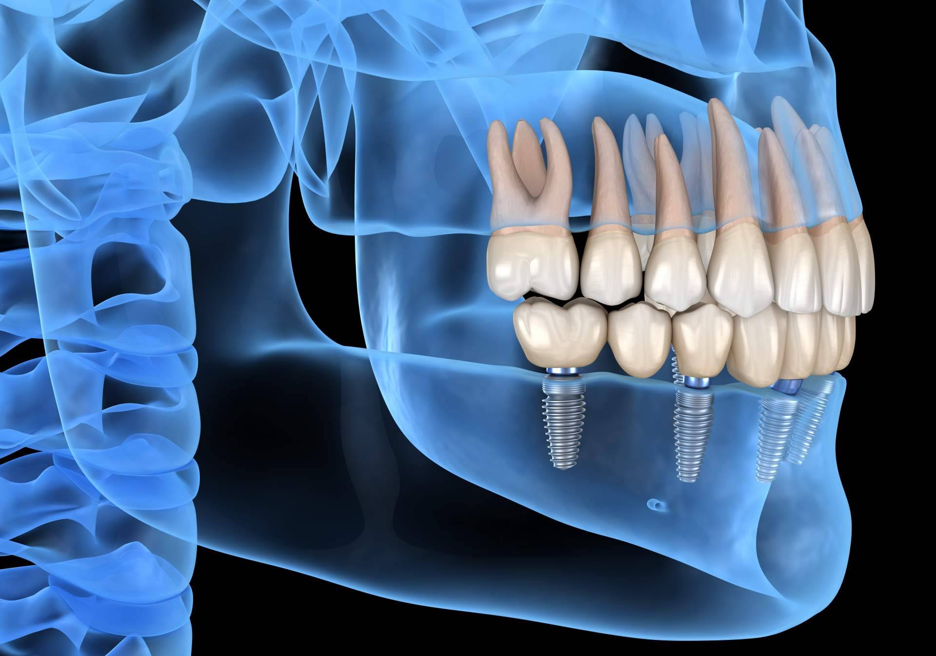 Implantes dentales de la mano de Clínica Dental de la Doctora Cachero