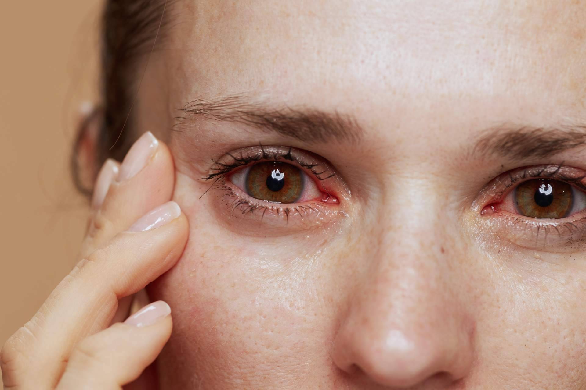 La solución perfecta para combatir el ojo seco