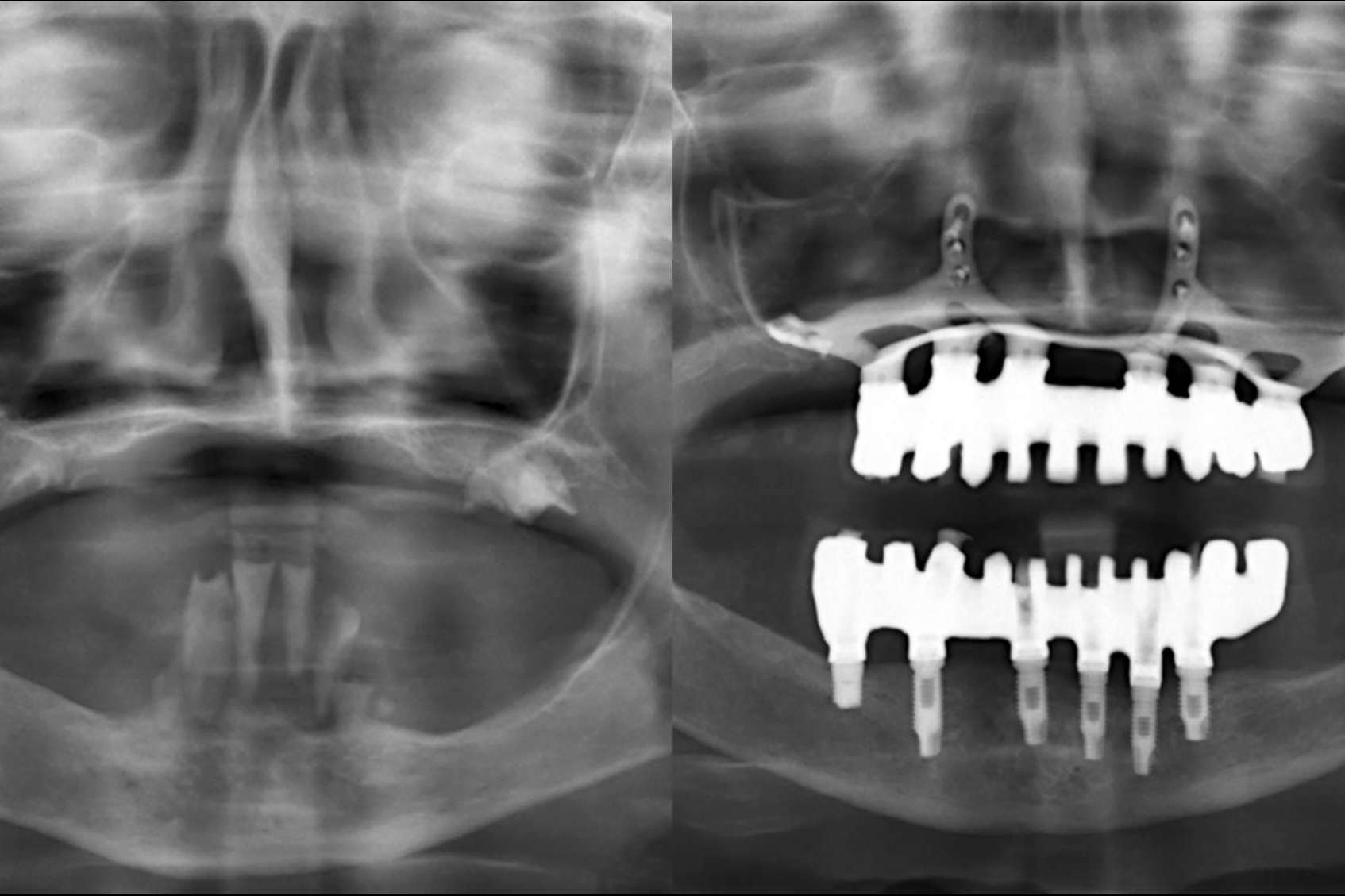 La Clínica Calvo de Mora en Madrid cuenta con expertos en implantes dentales