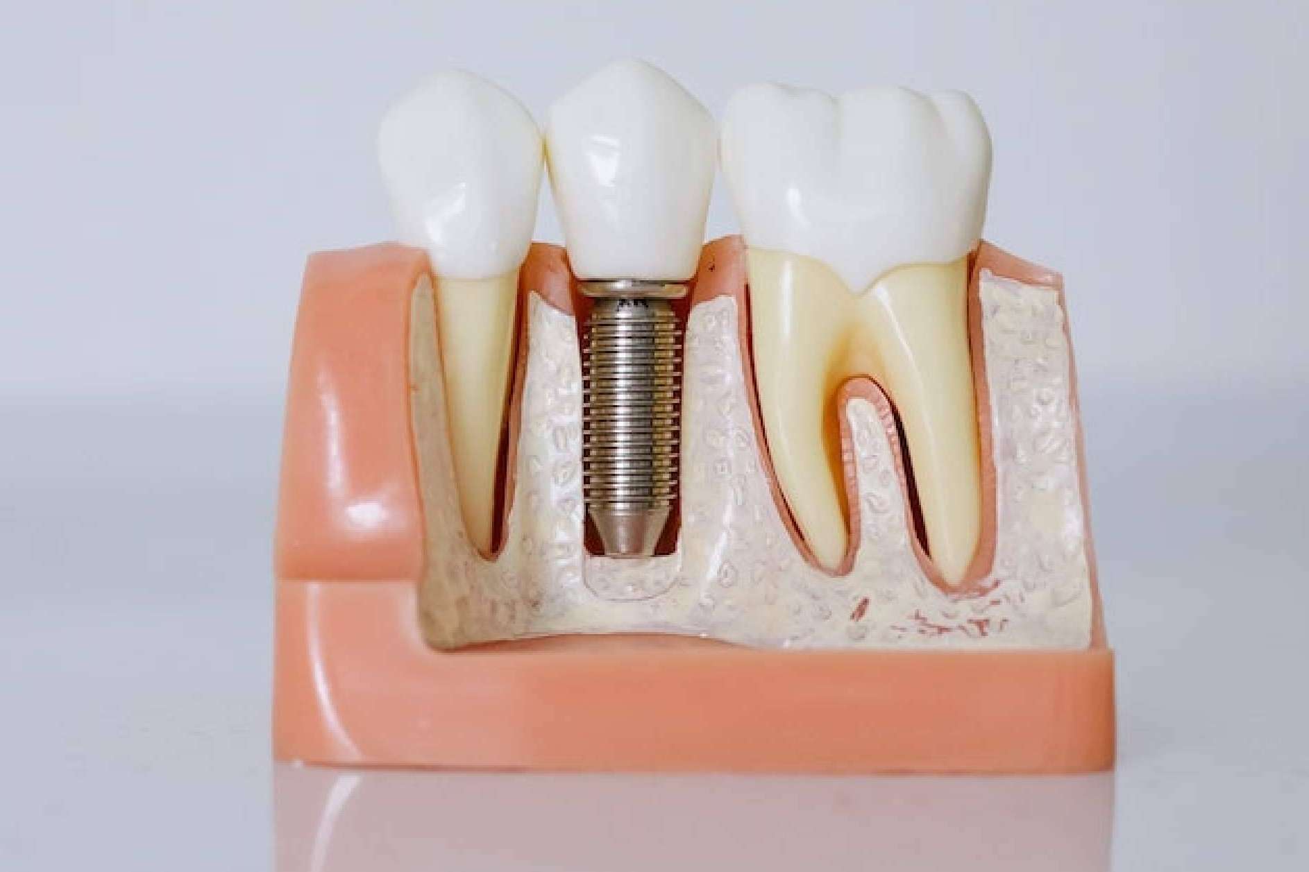 Descubrir el estándar de calidad en implantes dentales de Denty Dent en Madrid