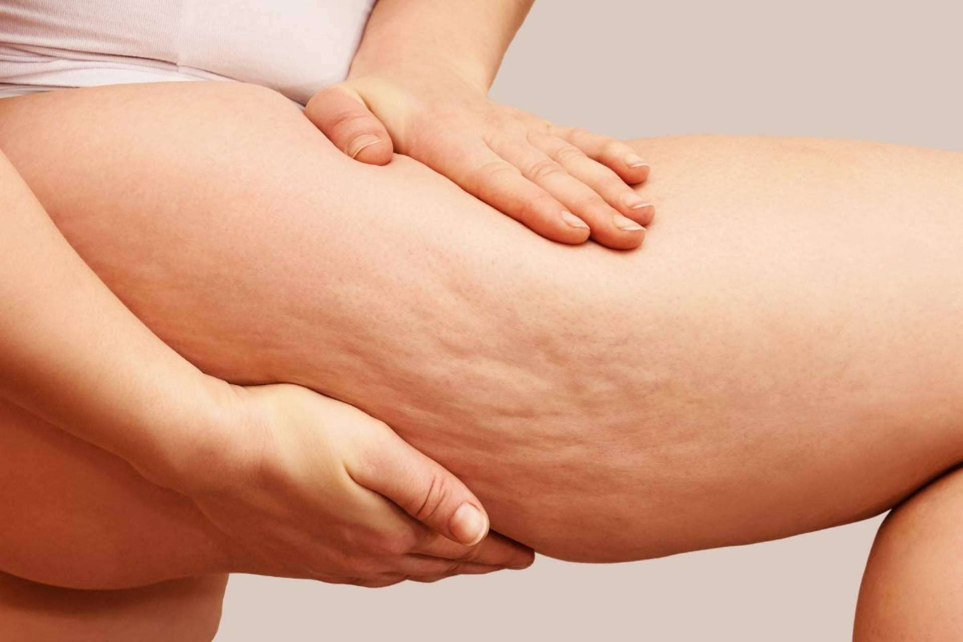 ¿Qué es la celulitis? Causas y soluciones