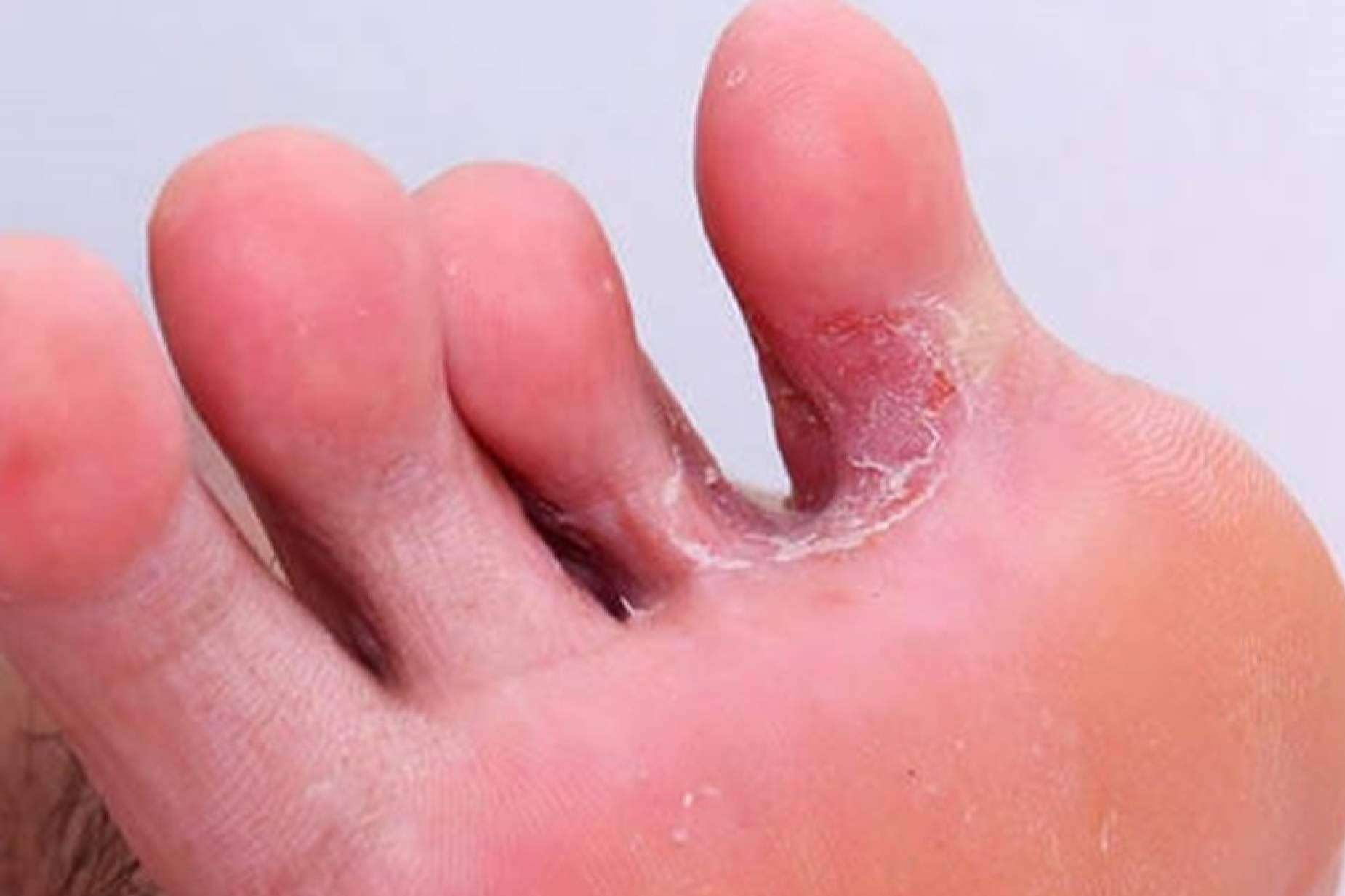 Evitar los hongos con Mycogel, de Laboratoires Bailleul