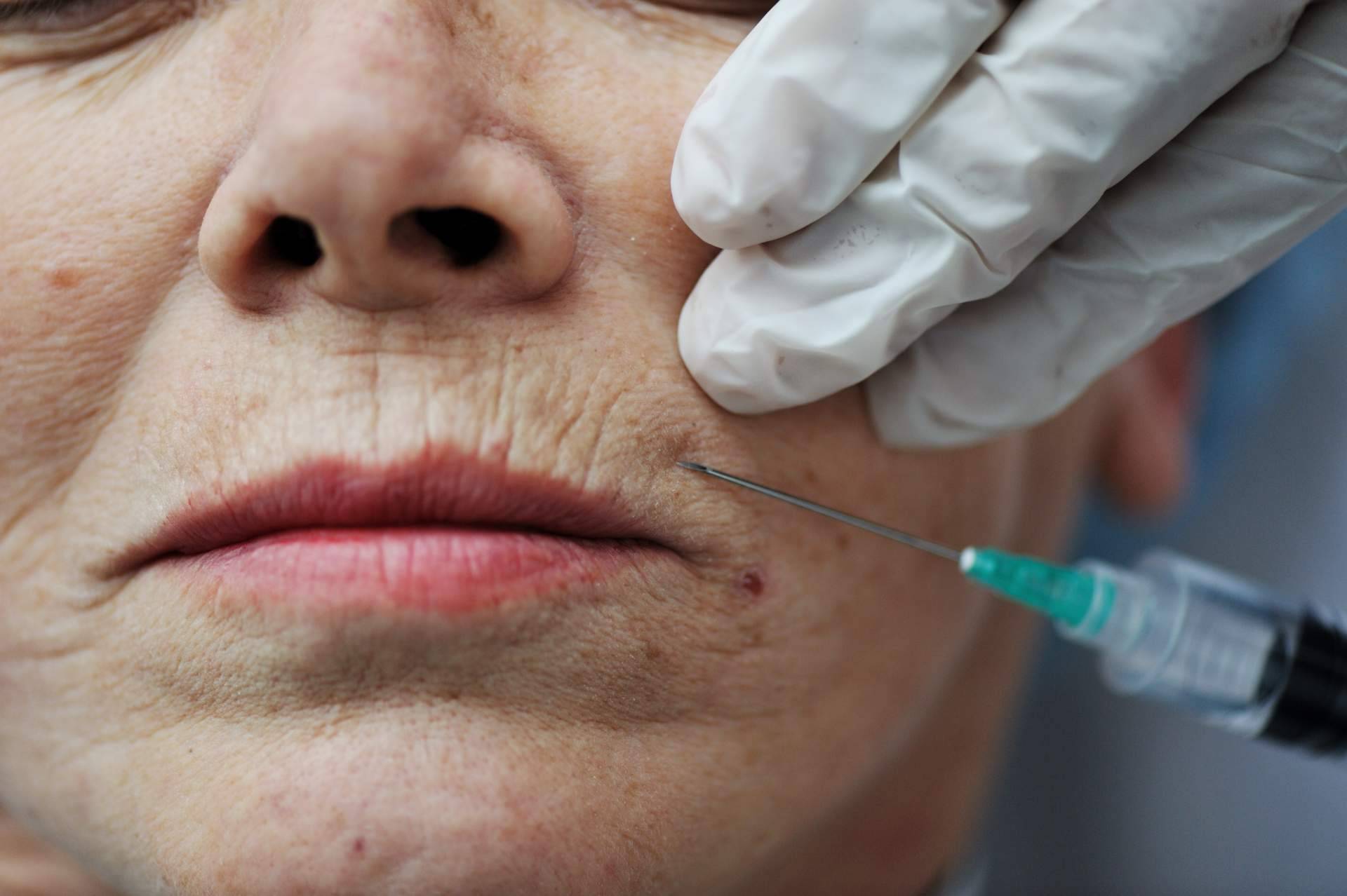 Tratamiento con plasma rico en plaquetas en el Centro Estética El Pilar