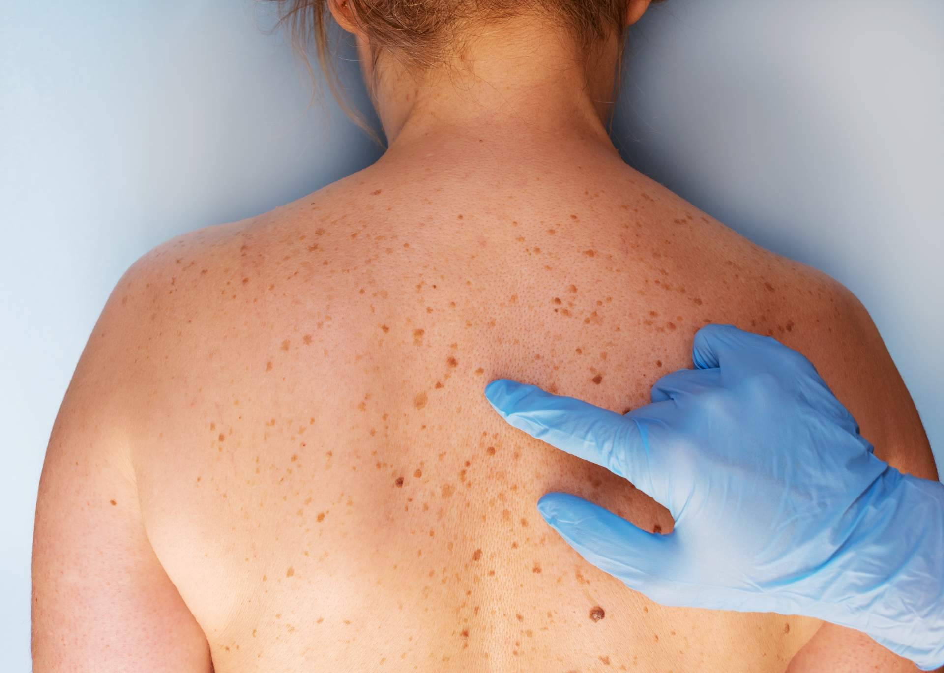 Tecnología de vanguardia para la eliminación de manchas en la piel, en el Centro Estética el Pilar