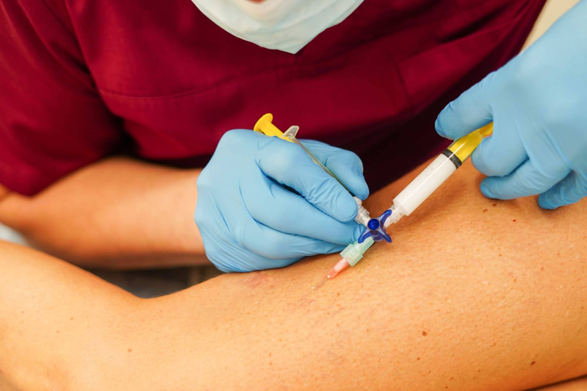 Las ventajas de eliminar las varices además del aspecto estético