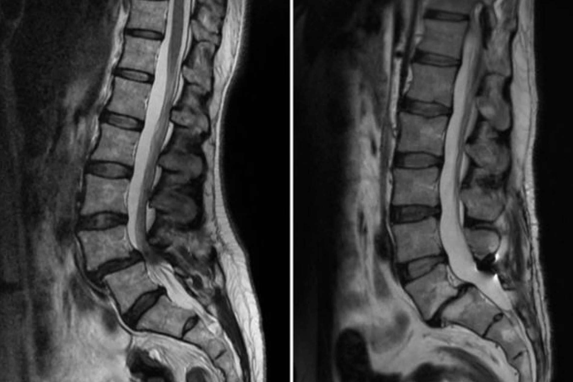 Listesis El Dr. Botella-Asunción habla sobre la Espondilolistesis Lumbar