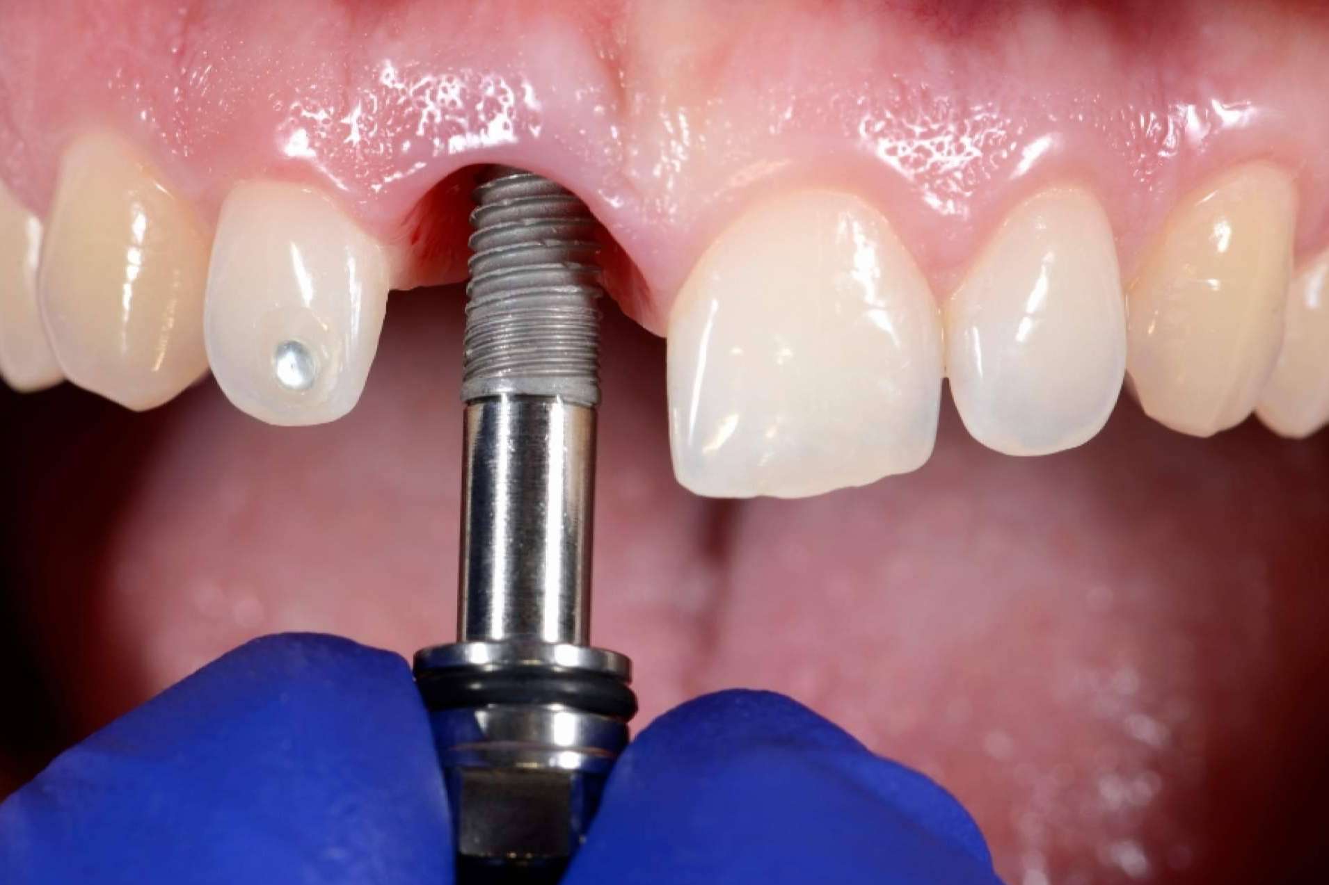Clínicas Nobel alerta sobre los riesgos de las ofertas en cirugías dentales