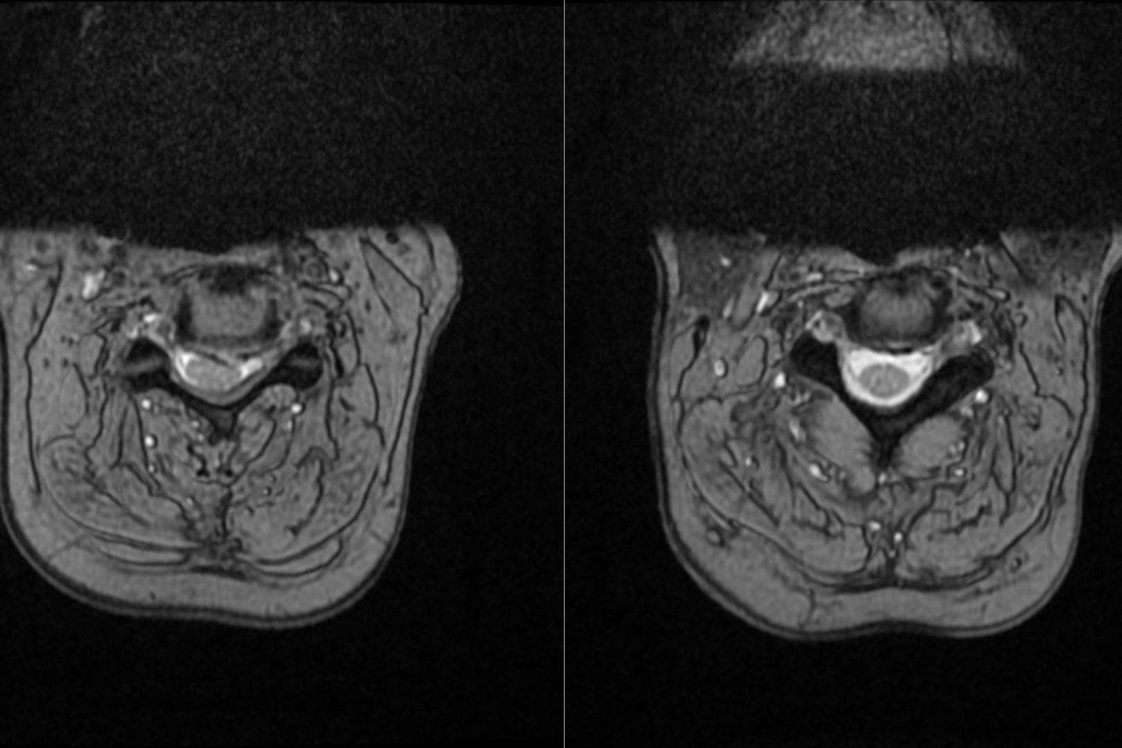 Tratamiento de la hernia discal cervical