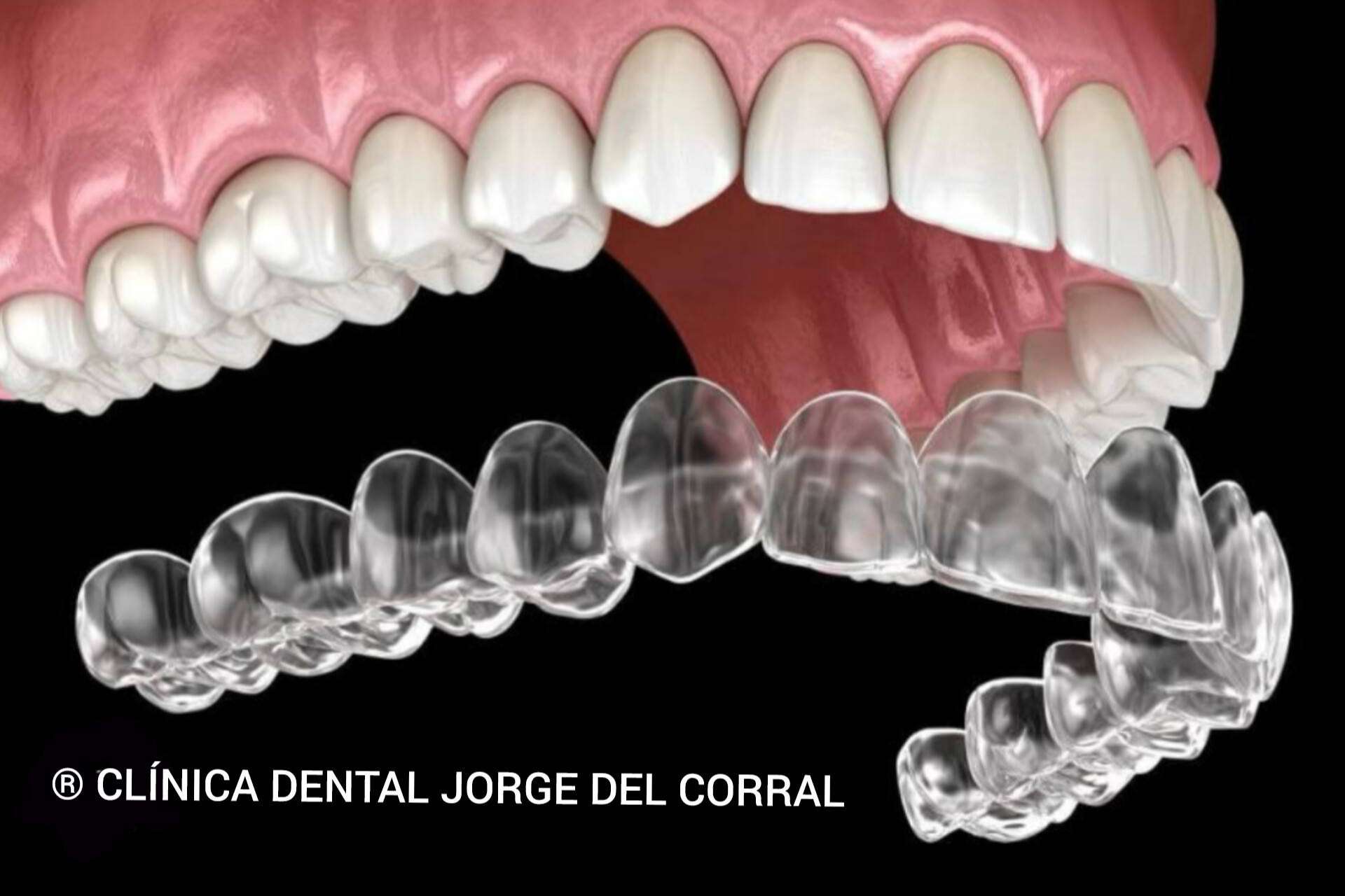 La Clínica Dental Jorge del Corral impulsa la ortodoncia invisible diseñada por ordenador en Hortaleza, Madrid