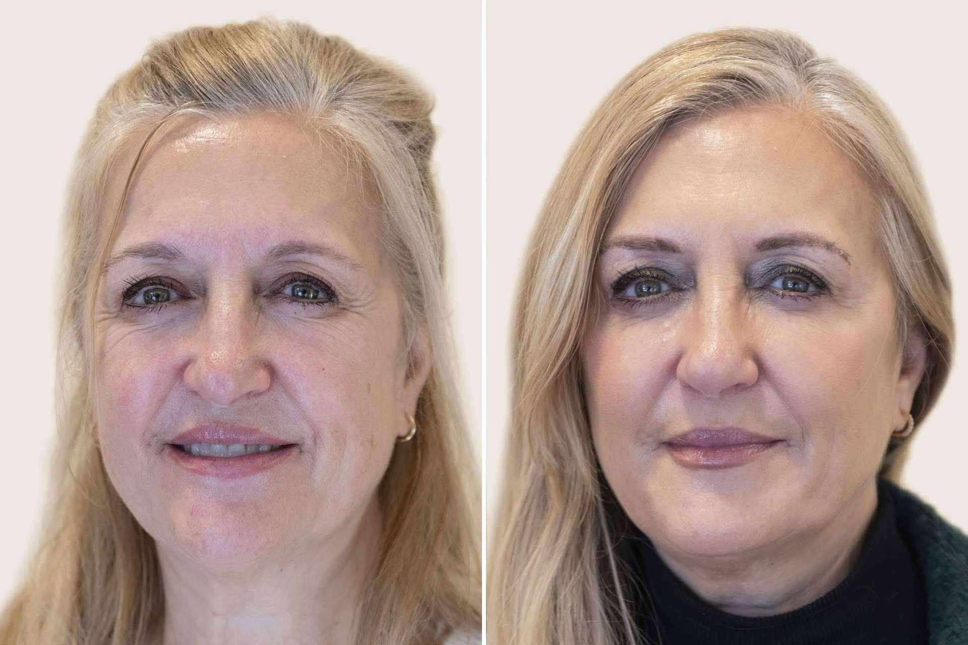 Armonización facial, el secreto ‘celeb’ para estar más guap@ a los 50 que a los 20