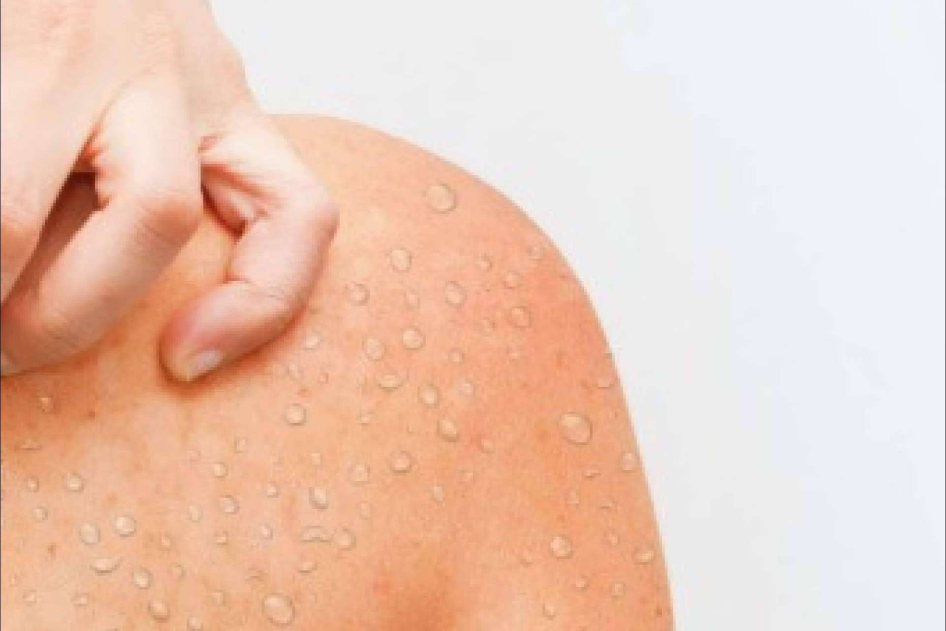 Micosis cutáneas; cómo prevenir los hongos en la piel durante el verano