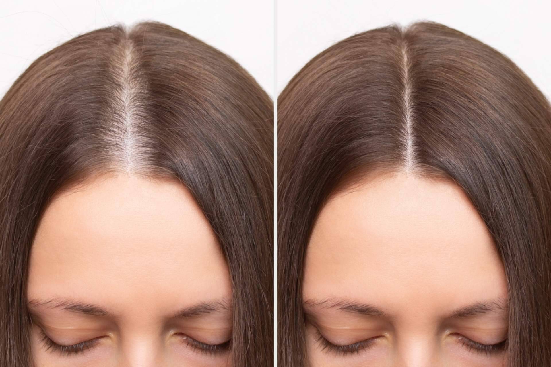 Estrés y caída de cabello ¿están relacionados?