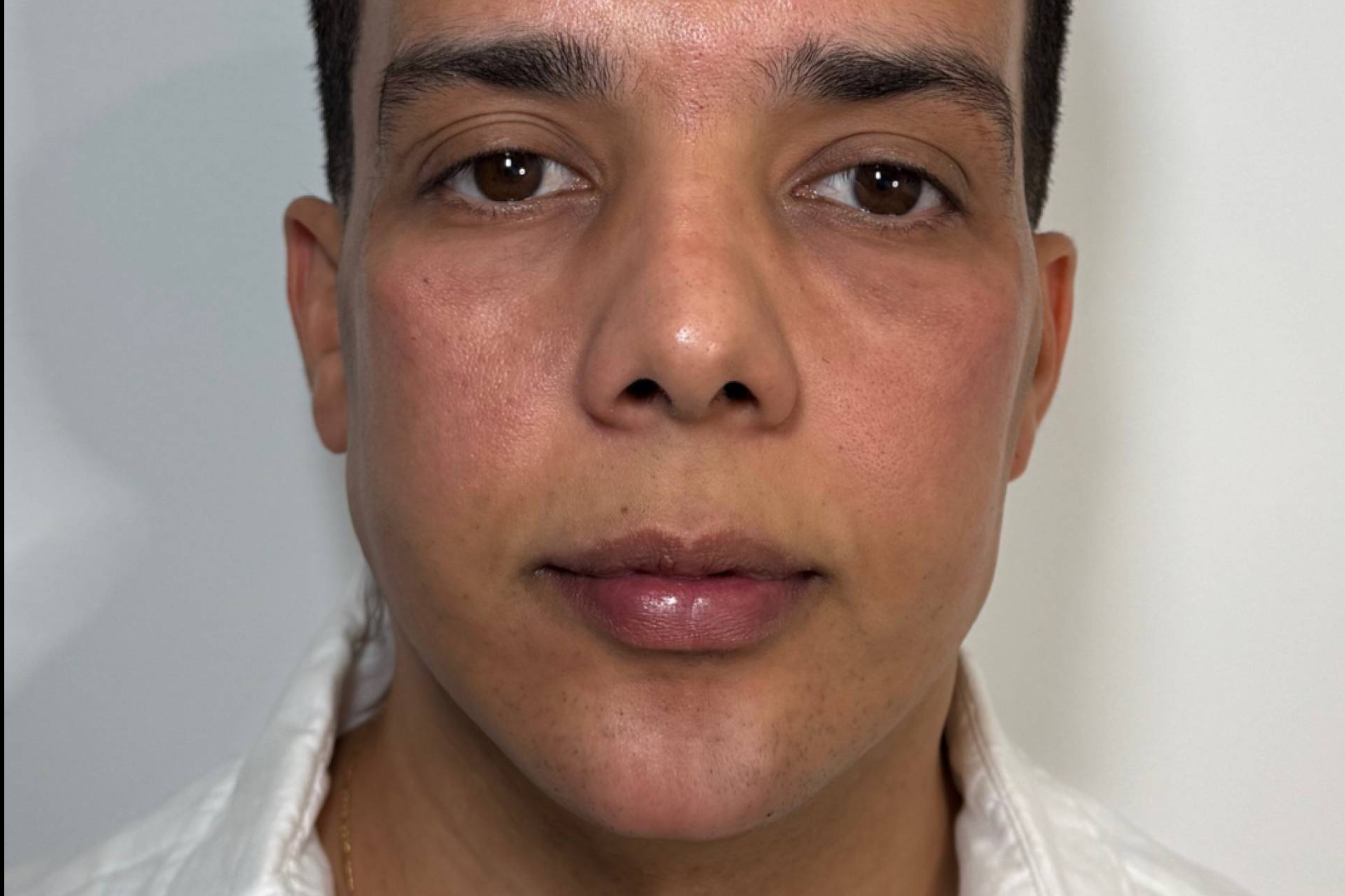 Masculinización facial sin cirugía, la propuesta estética de la Dra. Cecilia Arthur en Madrid