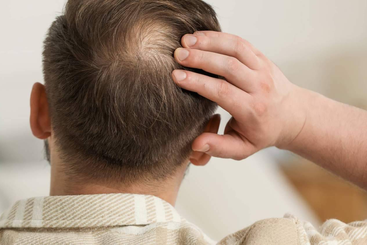 Revolución capilar; ¿pueden las células madre reemplazar los trasplantes?